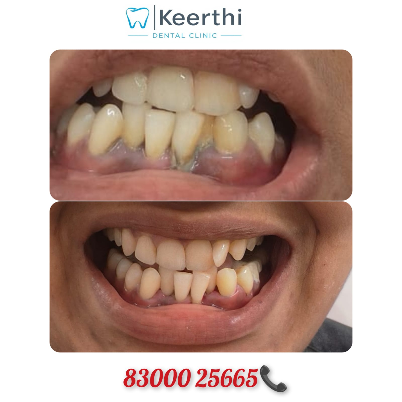 Dental Scaling (Teeth Cleaning) image 1