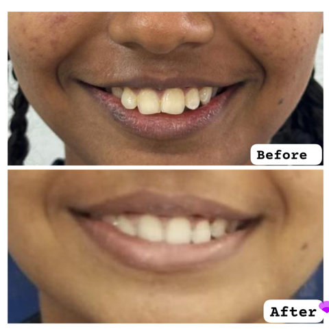 Smile Correction –Best Dental clinic in Pollachi