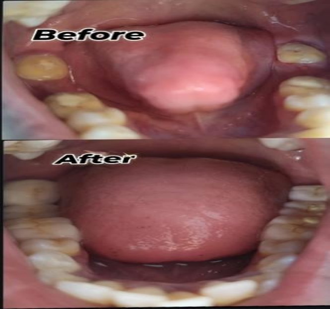 FPD (Fixed Partial Denture) Posterior Bridge Procedure in the best dental clinic in Dharapuram